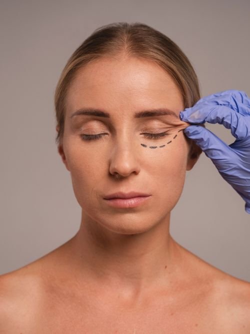 Blefaroplastia